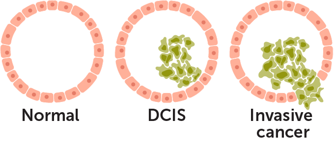 A microscope image of ductal carcinoma in situ